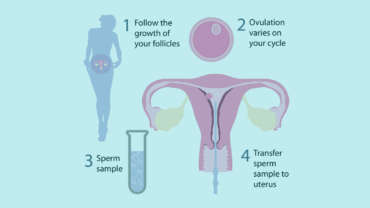 IUI (Intra Uterine Insemination) – Dr. PN