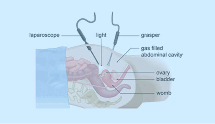 laproscopy-760x427